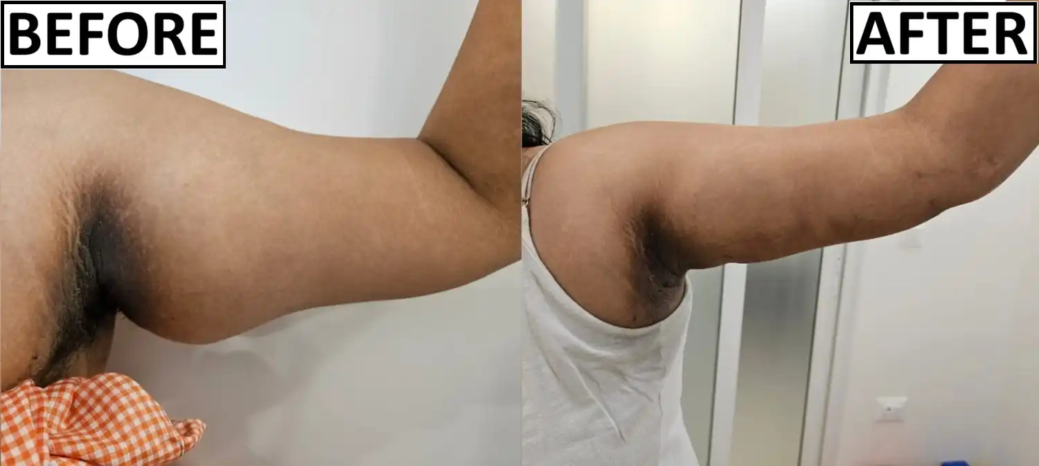 Arm Liposuction