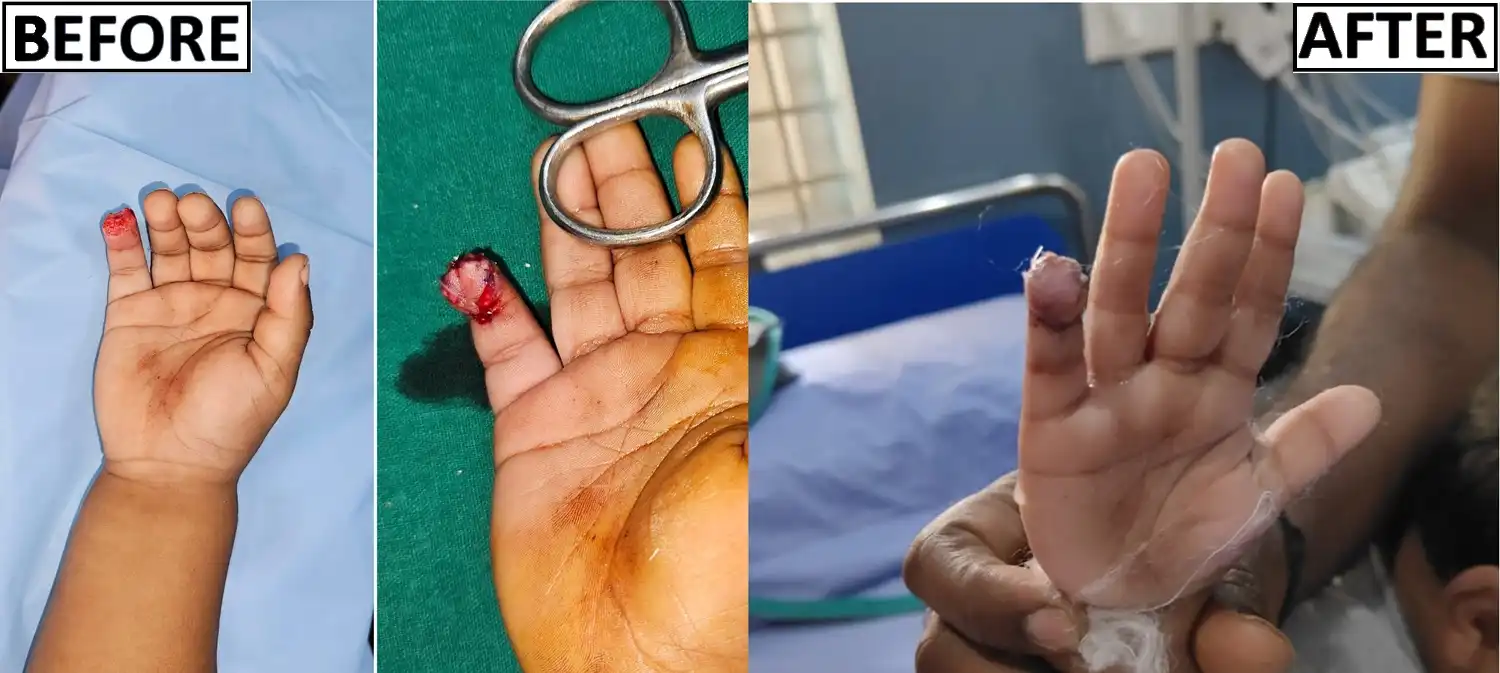 Fingertip Injuries